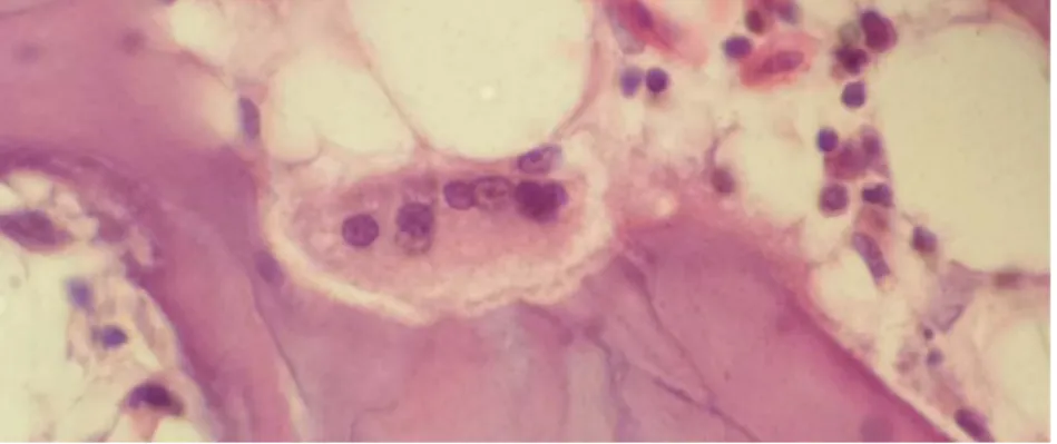 Figure 4: ostéoclaste multinuclées dans une lacune de Howship sur un os médullaire. 