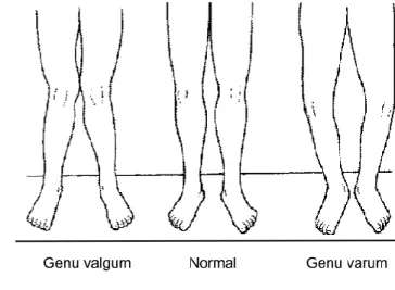 Figure 1.6 Différences entre genu valgum, un genou normal et genu varum (image adaptée de  [78]) 