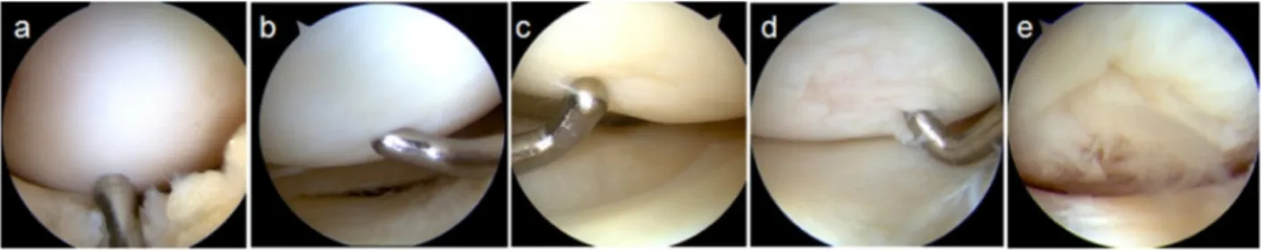 Figure  2.8:  Sample  arthroscopic  images  demonstrating  different  grades  of  the  modified  Outerbridge grading system