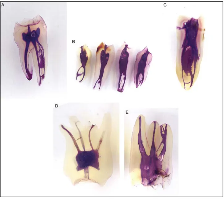 Figure 6 : exemples de variations canalaires anatomiques (Vertucci, 2005) :