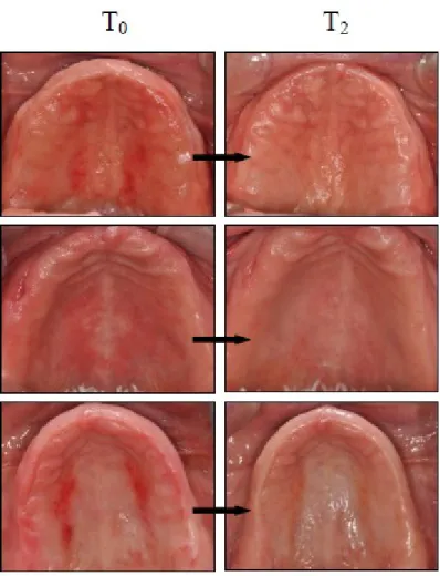 Figure 3.3: Palatal mucosa of patients at T 0  and T 2