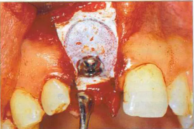 Figure 5: Ajustage d’une membrane GTAM. La membrane a été découpée et  galbée pour ménager un espace entre sa surface interne et l’implant [13] .