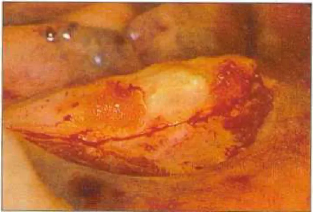 Figure 7: Incision décalée généralement vestibulaire [13]. 