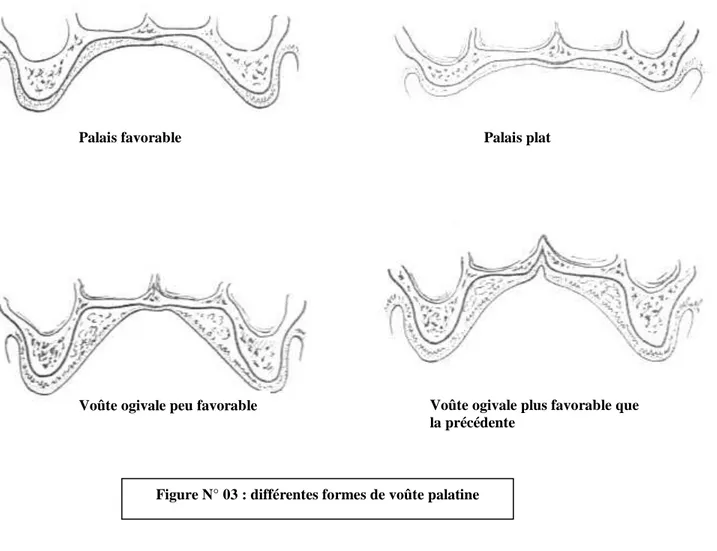 Figure N° 03 : différentes formes de voûte palatine 