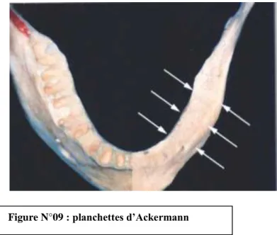 Figure N°09 : planchettes d’Ackermann 