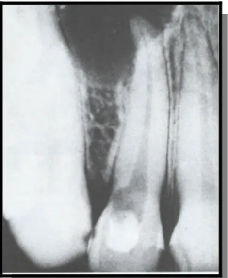 Fig. 9: Résorption cervicale au niveau de la 12. [25]