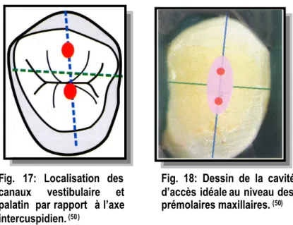 Fig. 17: Localisation des canaux vestibulaire et palatin par rapport à l’axe intercuspidien