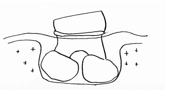 Figure 10c : simulation avec la présence de kystes radiculo-dentaires