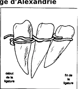 Figure 1 : (d’après Weinberger et Bardinet) Vue vestibulaire
