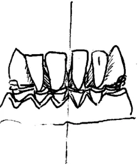 Figure 3 : Simulation en vue vestibulaire. La partie gauche est supposée