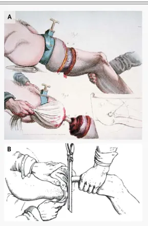 Figure 2.  Methods of Amputation in the Early 19th  Century.