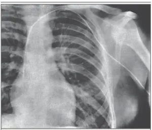Figure 5.  Radiograph of the Heart Self-Catheterized  by a Surgical Intern in 1929.