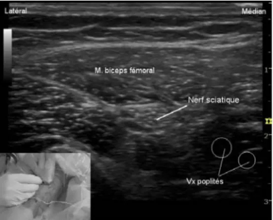 Figure 2.  Coupe échographique transversale d'un bloc du nerf sciatique par abord poplité postérieur