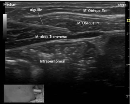 Figure 3. Coupe échographique sur l'abord postérieur du bloc du plan abdominal transverse (ou &#34;TAP bloc&#34;)  chez un enfant de neuf mois