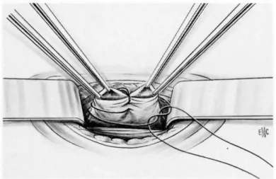 Figure 3. Fermeture du péritoine 2 . 