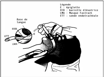 Figure 15 : En l’absence de résistance, la  sonde est poussée à travers les cordes  vocales, le Fastrach est maintenu jusqu’à  ce que la sonde soit complètement  enfoncée 