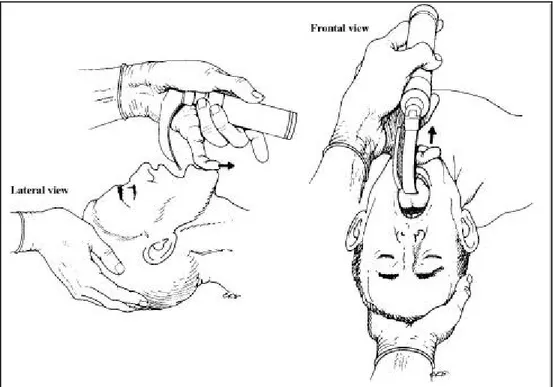 Figure 7 : Première étape de l’introduction du laryngoscope 