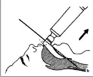 Figure 10 : Lésion des incisives  supérieures par un  mouvement de  bascule du laryngoscope 