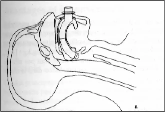 Figure  11. Copa en place : l’extrémité est  située juste au-dessus de l’épiglotte 