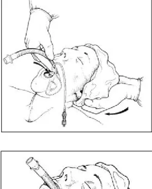 Figure 12 : Technique d’insertion du masque  laryngé 