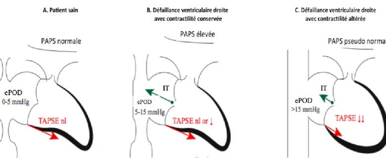 Figure 4 = évolution échocardiographique de la fonction ventriculaire droite en fonction du  stade de gravité de la maladie (ePOD = pression dans l’oreillette droite estimée, IT =  insuffisance tricuspidienne)