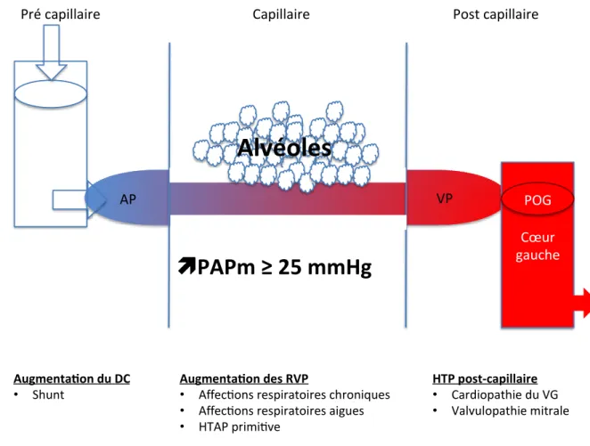 Figure 2 = principaux cadres étiologiques et physiopathologie de l’HTP (AP = artère  pulmonaire, HTP = hypertension post-capillaire, PAPm = pression artérielle pulmonaire  moyenne, POD = pression auriculaire droite, POG = pression dans l’oreillette gauche,