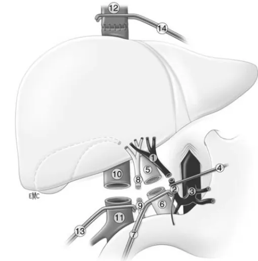 Figure 6 Transplantation hépatique avec clampage cave total. 1. Artère hépatique du greffon ; 2