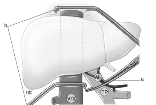 Figure 1 Segmentation du foie. Tronc porte (1) et ses branches droite (2) et gauche (3) ; Veines sus-hépatiques droite (4), médiane (5) et gauche (6) ; Drainage croisé des veines sus-hépatiques (7).