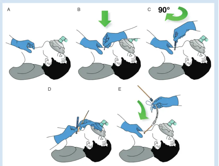 Fig 4 Cricothyroidotomy technique. Cricothyroid membrane palpable: scalpel technique; ‘stab, twist, bougie, tube’