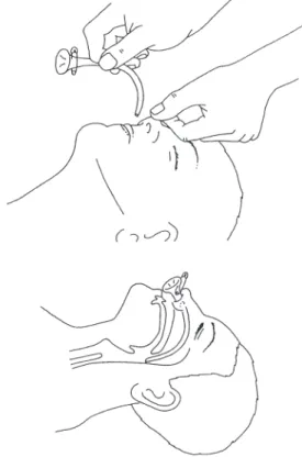 Fig 4.3 Nasopharyngeal airway
