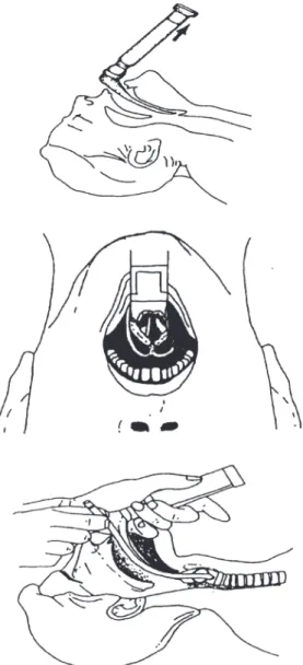Fig 4.7 Endotracheal tube insertion.