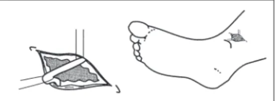 Fig 5.1 Cut down technique - long saphenous vein (right ankle).