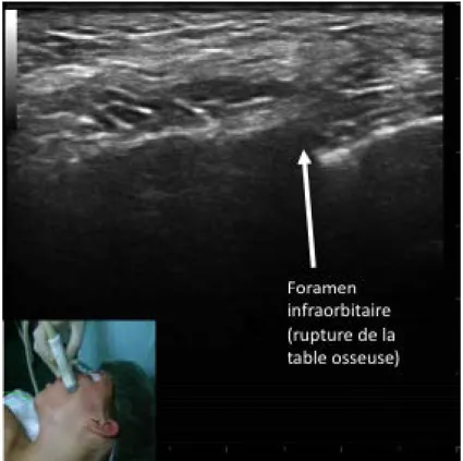 Figure 1.-  Image échographique du foramen infraorbitaire (sonde en position horizontale)