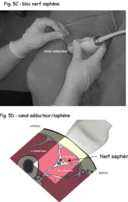 Figure 5.-  Bloc du nerf cutané latéral cuisse (NCLC) et nerf saphène. 