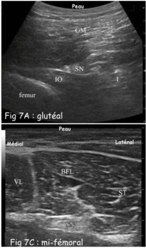 Fig 7.- Aspect échographique du nerf sciatique  de la fesse au creux poplité : SN (nerf sciatique), T (tibial) F  (fibilaire), BFL (biceps fémoral long), ST (semi-tendineux), GM (muscle gulteal), VL (vaste latéral)