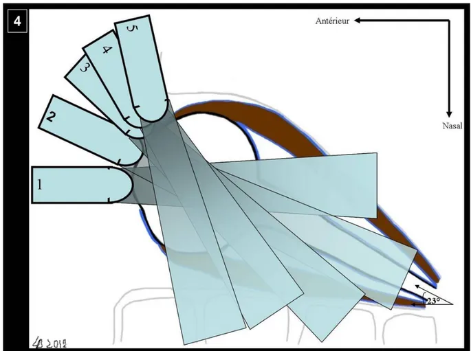 Figure 4. Schéma d’une coupe horizontale de l’orbite. Est représenté le mouvement de la  sonde, rotation et inclinaison pour réaliser un scan échographique du quadrant nasal de  l’orbite