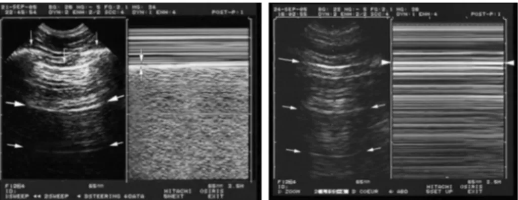 Figure 6 –  Poumon normal et pneumothorax