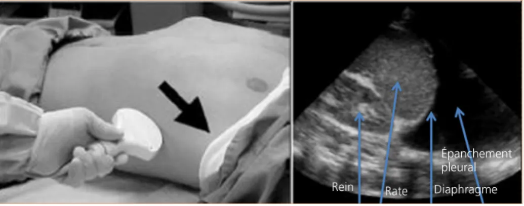 Figure 9 –  Épanchement pleural liquidien.
