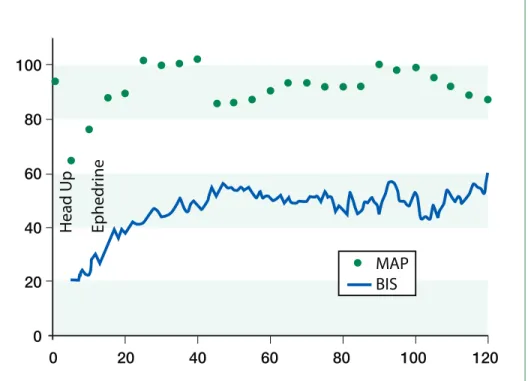 Figure 1. 120 min BIS and MAP trend during orthostatic hypotension treated with ephedrineHeadUpEphedrine100806040200020406080 100 120MAPBIS