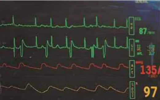 Figure 1. Artifact in lead V could be mistaken for PVCs.