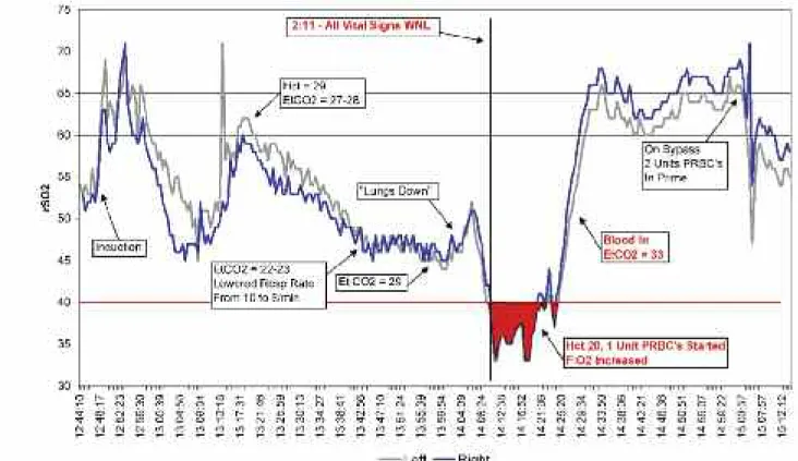 Figure 3. Cerebral oximetry values and time-line of events during a cardiac surgical procedure.First Alert - Unknown Blood Loss