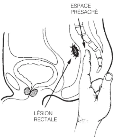 FIGURE 8 ESPACE PRE ´ SACRE´ INCISION LE ´ SION RECTALE