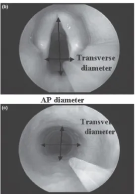 Figure 3 : (b) image de la glotte par vidéo-bronchoscopie. (c) image du cricoïde par video-bronchoscopie (AP= 