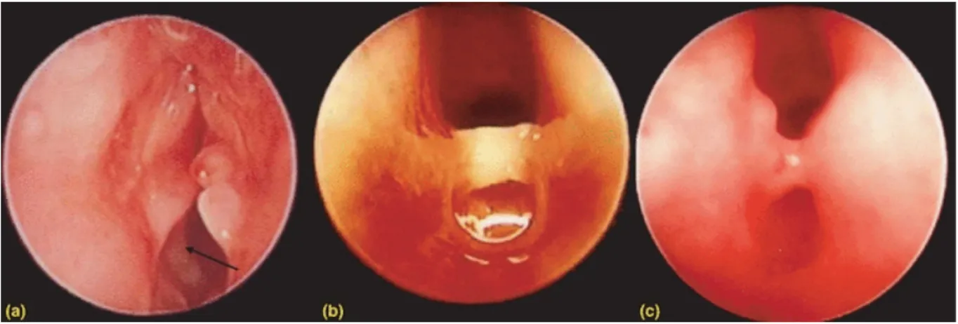 Figure 2 (1) : Trois stades de développement d’une cicatrice après des lésions laryngées causées par des SIATB  trop  large  placées  dans  le  larynx