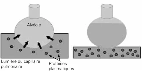 Figure 1 :  lors de l’œdème pulmonaire hydrostatique, il y a un transfert de liquide  hypo-oncotique de la lumière du capillaire pulmonaire vers la lumière alvéolaire  (A), aboutissant, in fine, à une détresse respiratoire et à une augmentation de  la prot