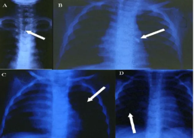 Figure 5 : Aspects radiologiques possibles en cas de corps étranger bronchiques de l'enfant.
