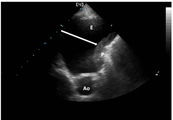 Figure 4 : Epanchement pleural liquidien : Vue transversale d’un épanchement pleural liquidien (E)  : zone anéchogène transonore (noire, libre d’écho) permettant la visualisation de l’Aorte en coupe  transverse (Ao) et d’un collapsus pulmonaire (P)