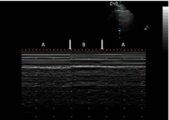 Figure 5 : Visualisation en mode TM du point poumon : zone de transition où on observe le  pneumothorax et le poumon à la paroi