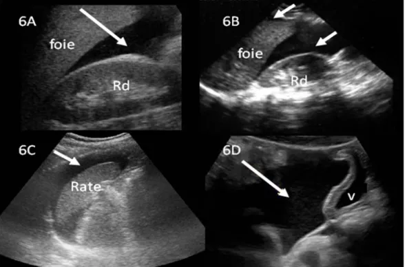 Figure 6 : Epanchement péritonéal liquidien:  6A, 6B : Vues longitudinales du quadrant  abdominal antéro-supérieur droit