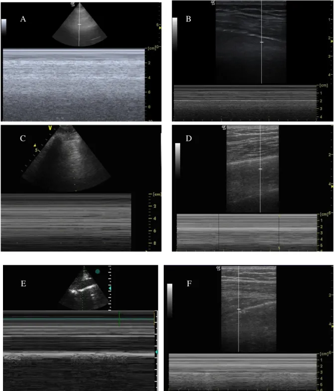 Figure 5. Dignostic échographique de pneumothorax. 